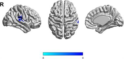 Effects of APOE ε2 on the Fractional Amplitude of Low-Frequency Fluctuation in Mild Cognitive Impairment: A Study Based on the Resting-State Functional MRI